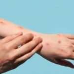 பொகவந்தலாவையில் அறுவருக்கு சிக்குன்குனியா நோய்