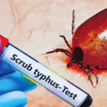 ஆந்திராவில் 1,592 பேருக்கு உண்ணிக் காய்ச்சல்; தமிழகத்திலும் பரவலாம்